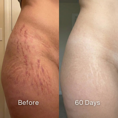 Scar Renewal - Advanced Medical Silicone