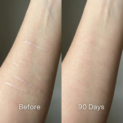Scar Renewal - Advanced Medical Silicone