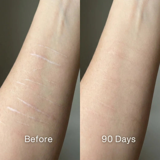 Scar Renewal - Advanced Medical Silicone