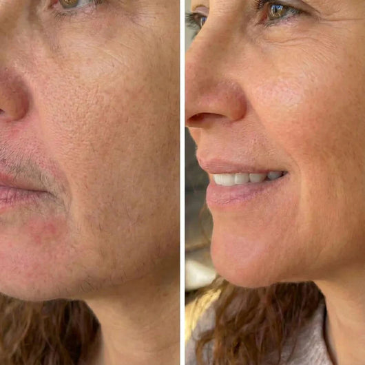 Sypelume™ - Sérum Anti-Repousse