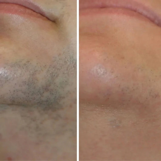 Sypelume™ - Sérum Anti-Repousse