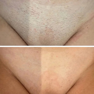 Sypelume™ - Sérum Anti-Repousse