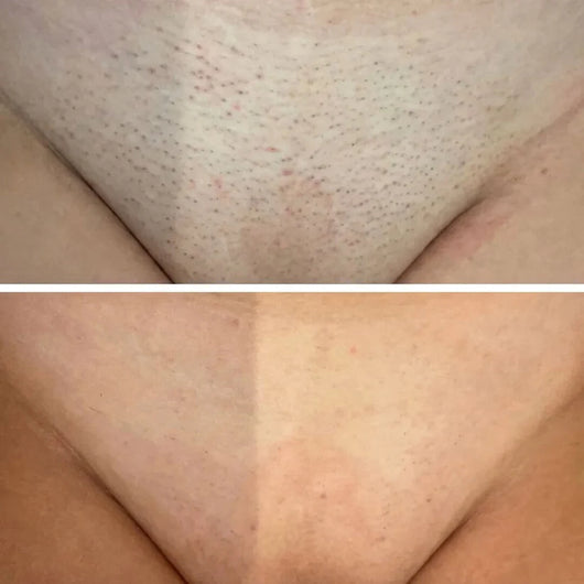 Sypelume™ - Sérum Anti-Repousse